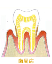 歯周病