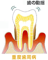 重度歯周病